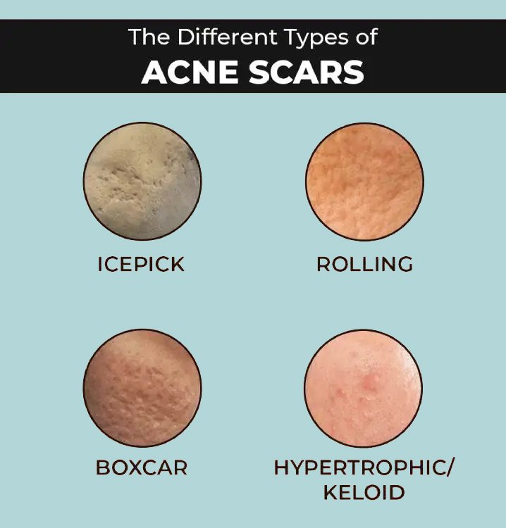 Acne Scars Treatment in Delhi